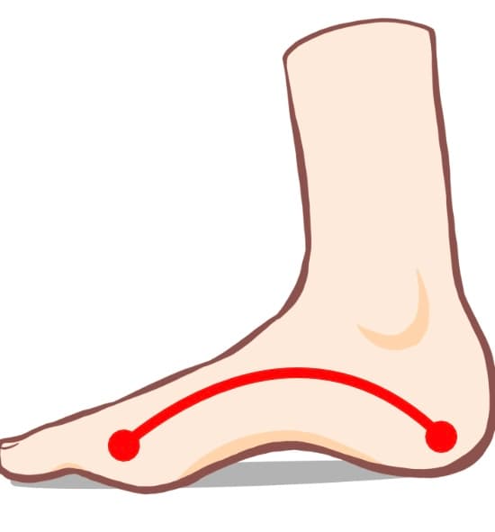 凹足（ハイアーチ）